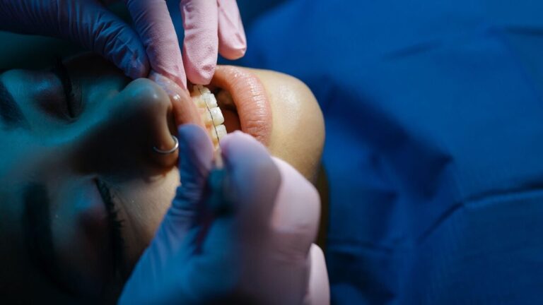 Gros plan sur un appareil dentaire posé sur des dents, dont le prix varie beaucoup selon la technique